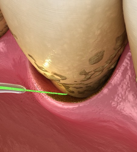 Illustration of laser gum disease treatment