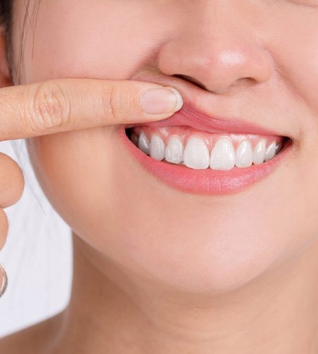 Woman pointing to her gums
