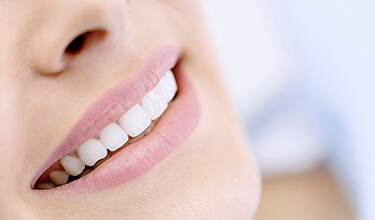 closeup of a woman's smile after cosmetic dentistry in Carrollton