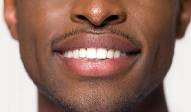 Closeup of smile treated by Carrollton cosmetic dentist
