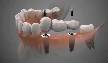 Digital illustration of implant dental bridge in Carrollton