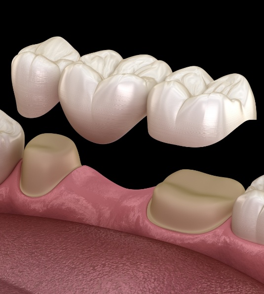 Illustration of dental bridge in Carrollton being placed on lower teeth