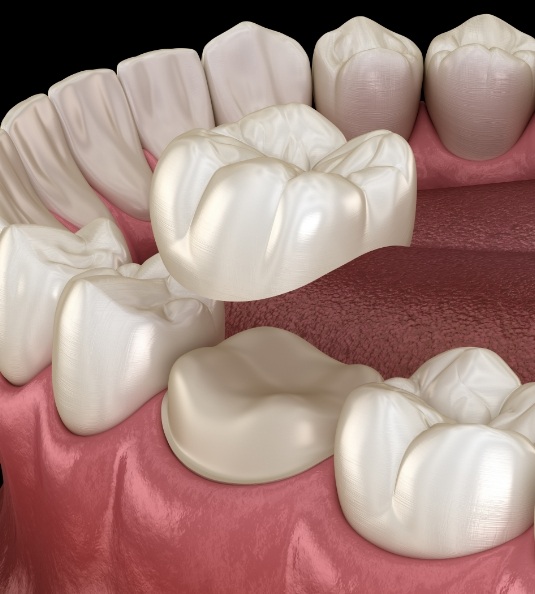 Illustration of dental crown in Carrollton being placed on tooth