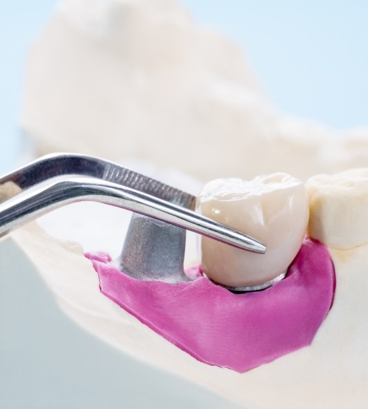 Illustration of dental instrument picking up crown from model of teeth