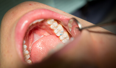 closeup of mouth during dental checkup