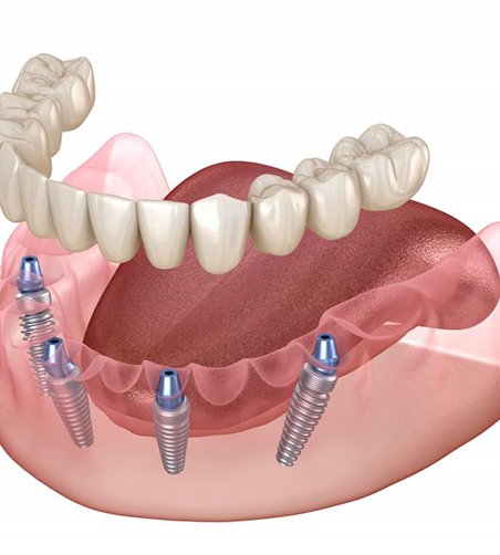 Illustration of All-on-4 denture