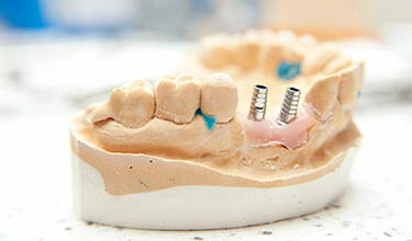 dental implants anchor