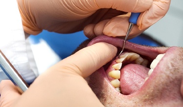 A man having his gums cleaned