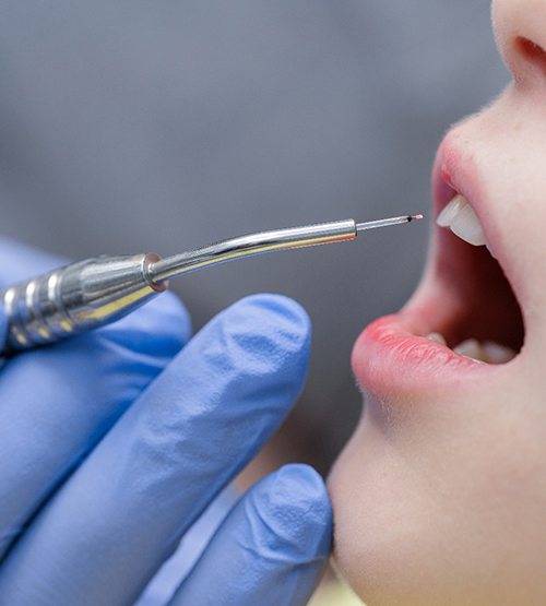 Gum recontouring uses a soft tissue laser to reshape the gums