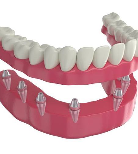 Illustration of implant denture against white background