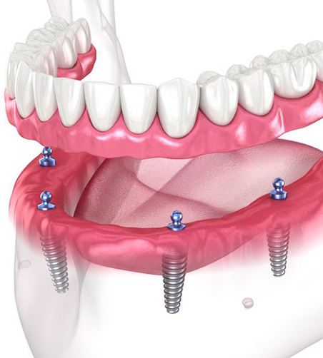 Illustration of removable implant denture for lower arch