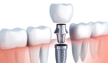 Diagram of dental implants being placed in Carrollton