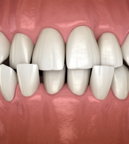 Illustration of a crossbite