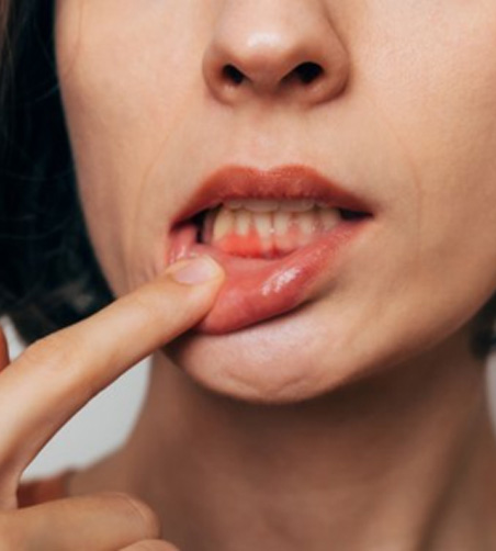 Woman pulling back her lip to reveal red, swollen gums