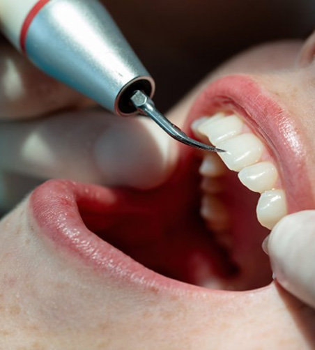Close up of a dentist using a soft tissue laser to treat patient’s gum disease
