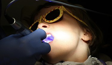 A dentist using a curing light to harden the plastic dental sealant on a patient’s back tooth