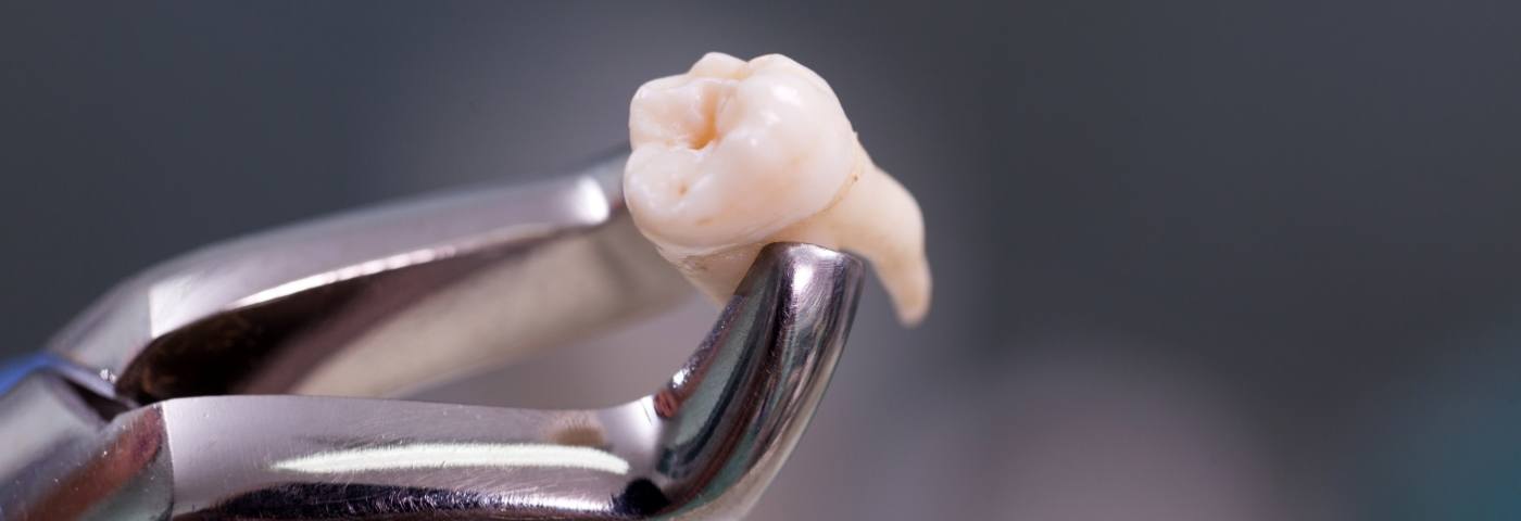 Forceps and tooth after tooth extraction in Carrollton
