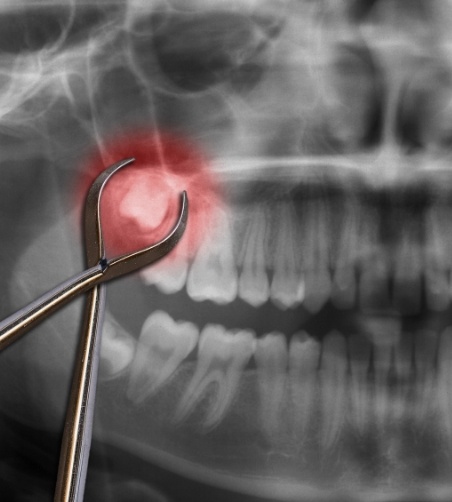 X ray showing an impacted wisdom tooth