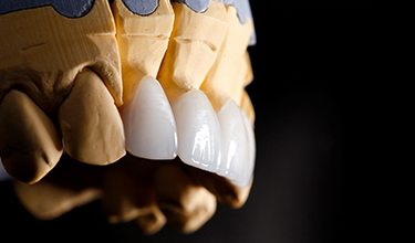 a plaster model of a mouth with dental veneers placed over the teeth