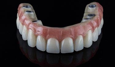 a denture made to fit atop dental implants