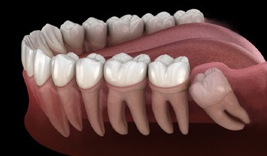 3D illustration of wisdom teeth 
