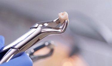 closeup of dentist holding extracted wisdom tooth  
