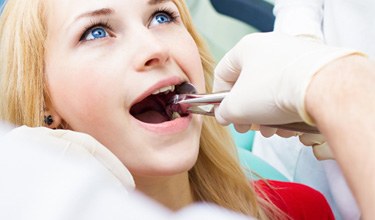 dentist performing wisdom tooth extraction   