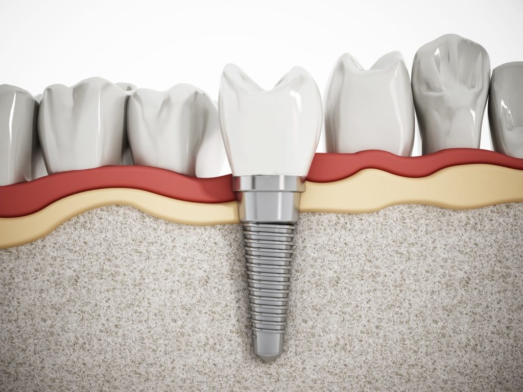 side view of dental implant