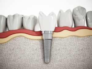 Treat your tooth loss with dental implants in Carrollton.