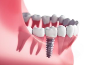 model of dental implant