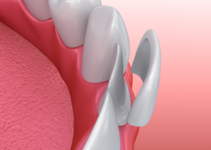 Model of veneer on lower tooth