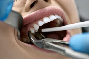 Tooth extraction procedure.